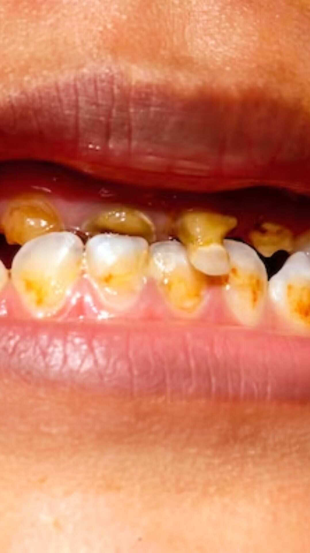 6 home remedies for yellow teeth